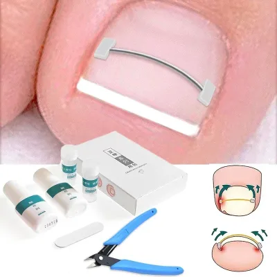 Correcteur d'ongles incarnés, fil et colle