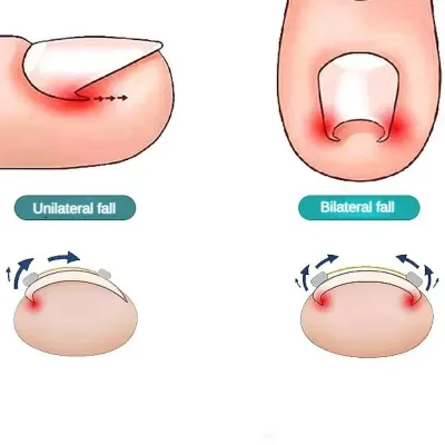 Correcteur d'ongles incarnés, fil et colle – image 3